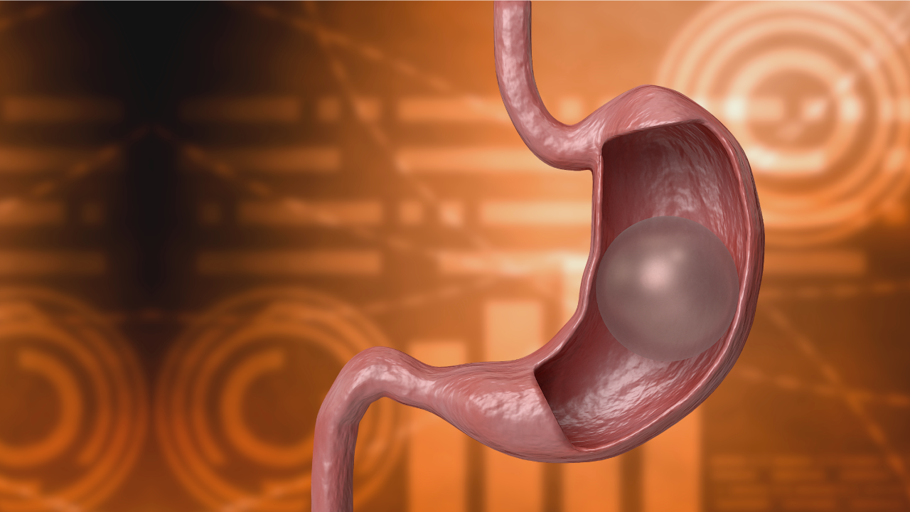 The most commonly asked questions about the Gastric Balloon
