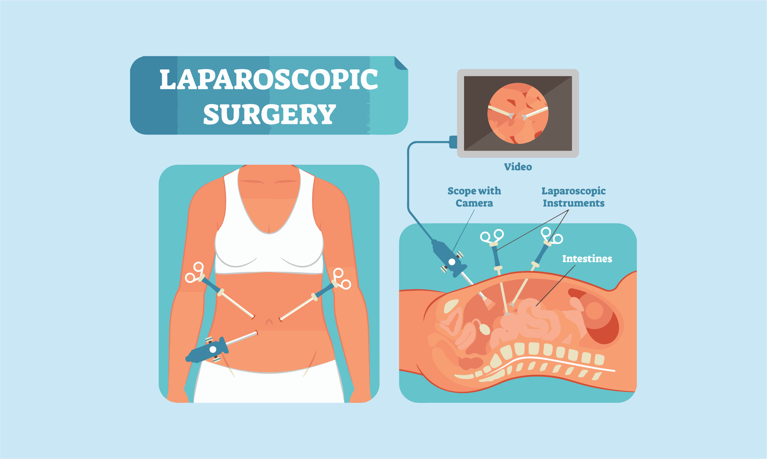 La laparoscopie
