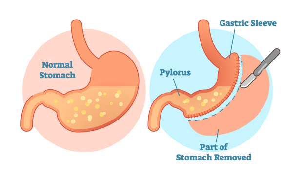 Doctor Mahmut Dogan Gastric Sleeve Surgery Stomach